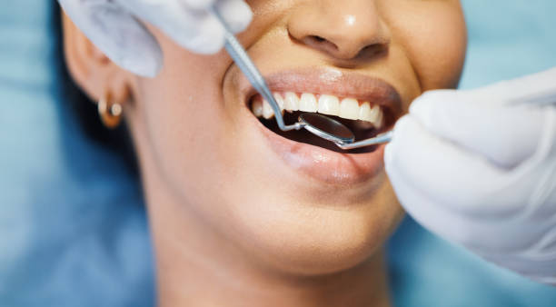 Emergency Dental Filling Replacement in TX